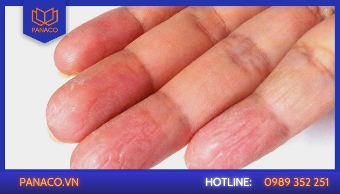 Khóa điện tử lỗi nhận diện (Vân tay không nhạy_nhận chậm)